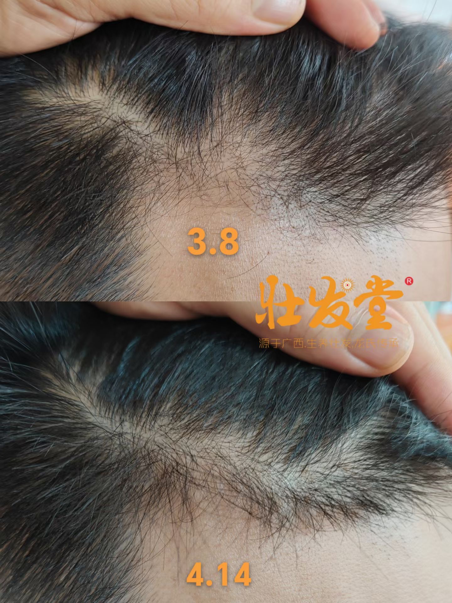 鬓角发际线一个多月效果